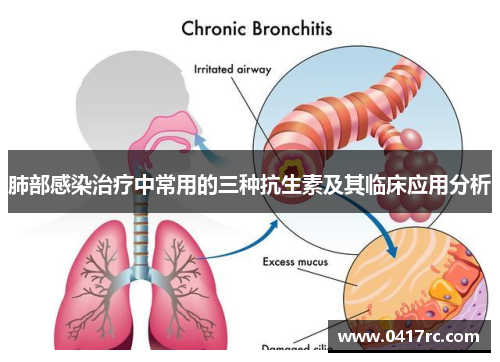 肺部感染治疗中常用的三种抗生素及其临床应用分析